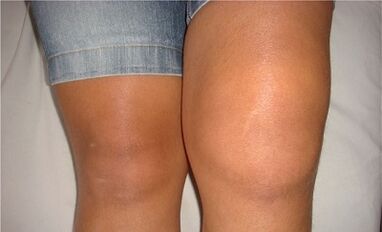 Causes Arthrosis knee joint
