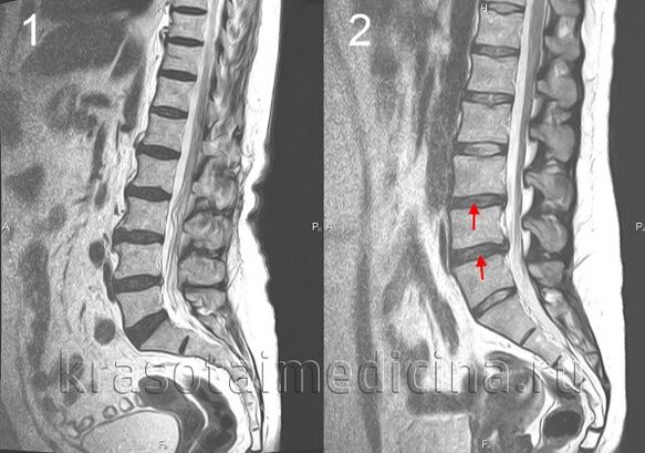 Osteochondrosis of spine