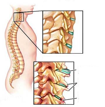 Comparison of a healthy and sick spine in the neck