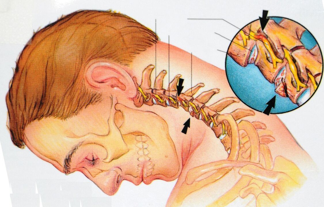 Osteochondrosis of cervical regions