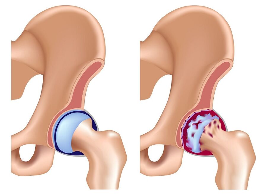 Healthy wrist and Arthrosis hip joint